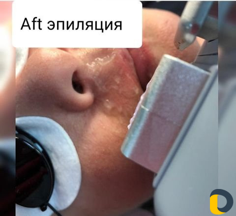 Aft эпиляция