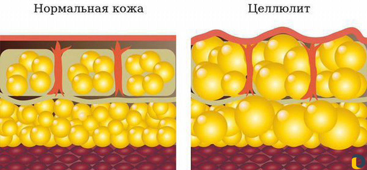 Антицеллюлитный массаж
