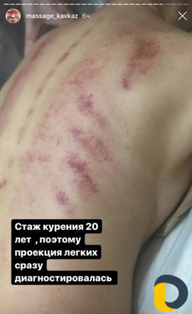 Антицеллюлитный массаж