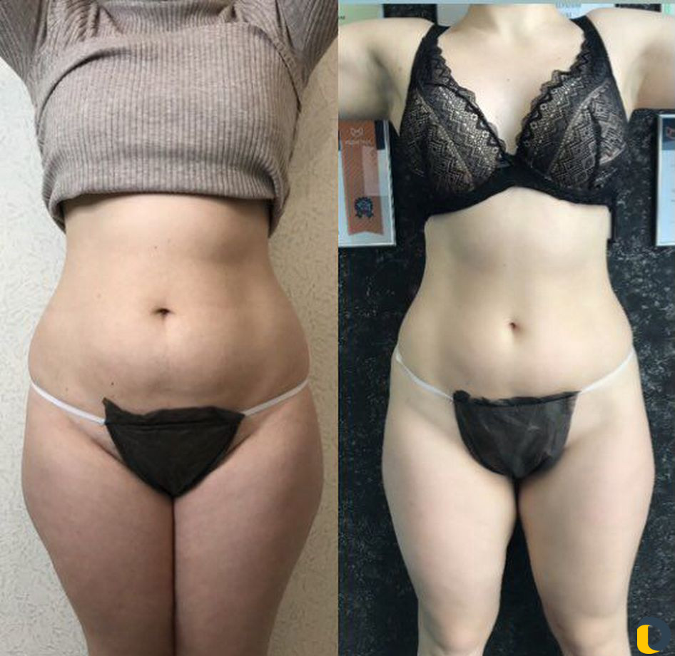 Аппаратный массаж