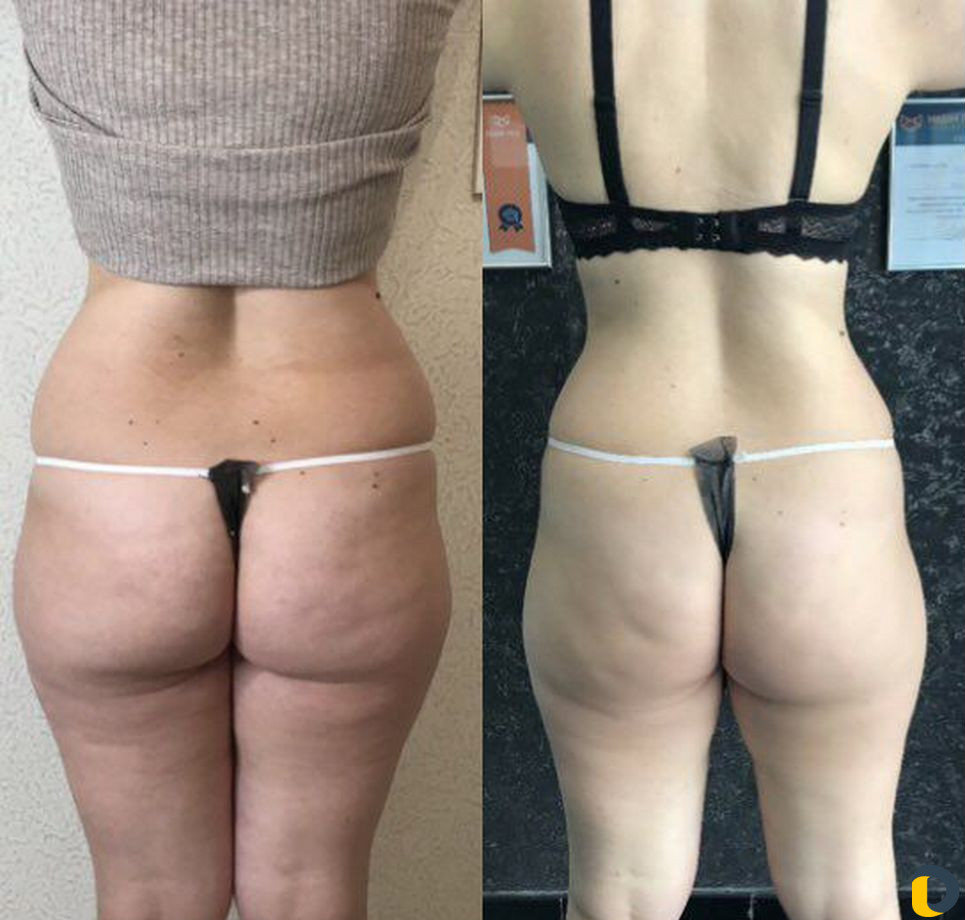 Аппаратный массаж