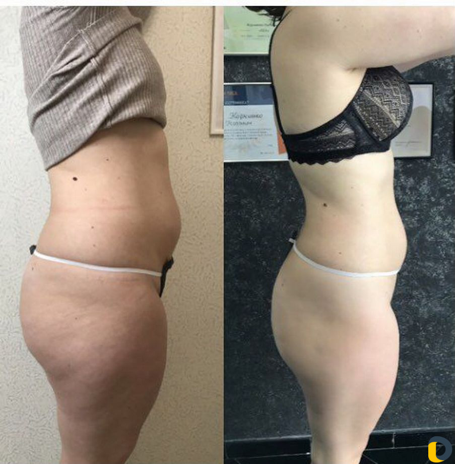 Аппаратный массаж