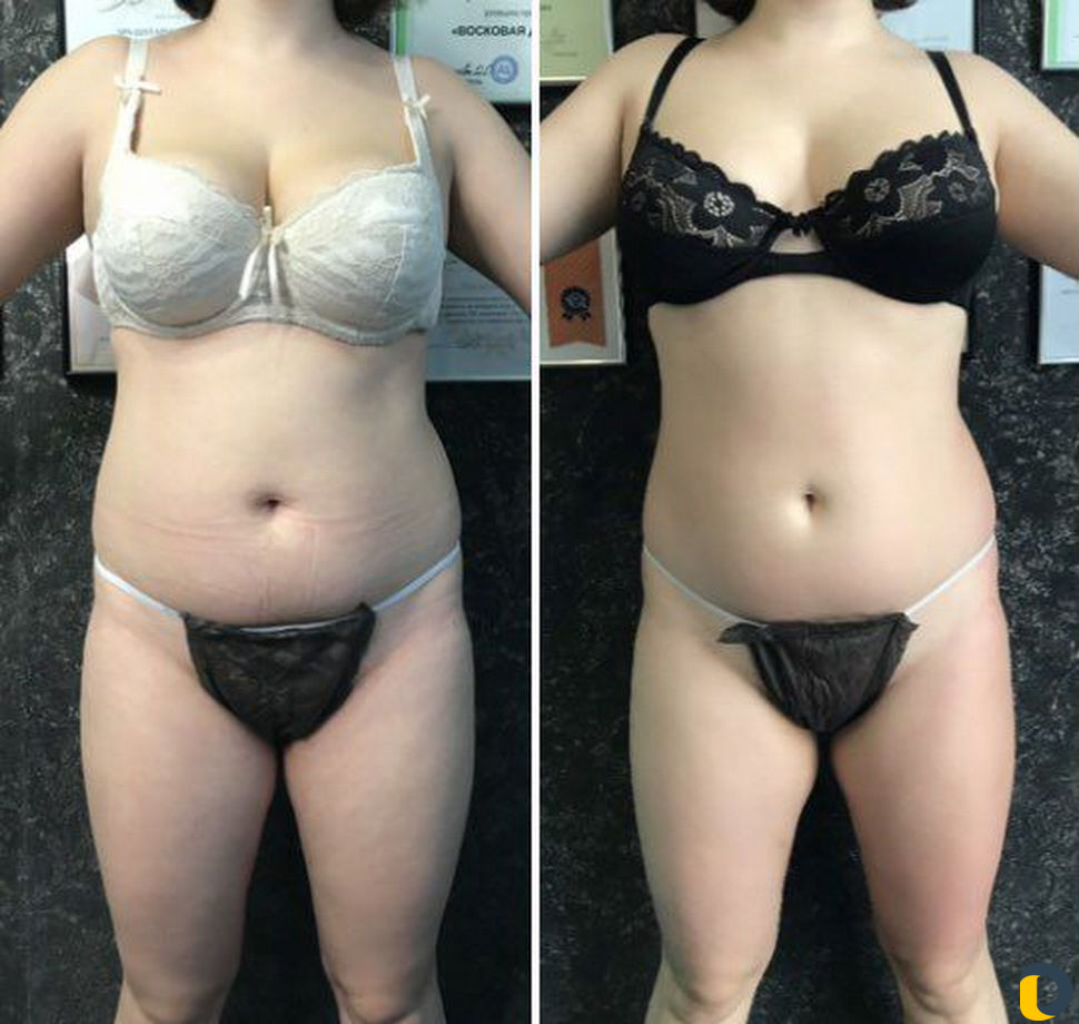 Аппаратный массаж