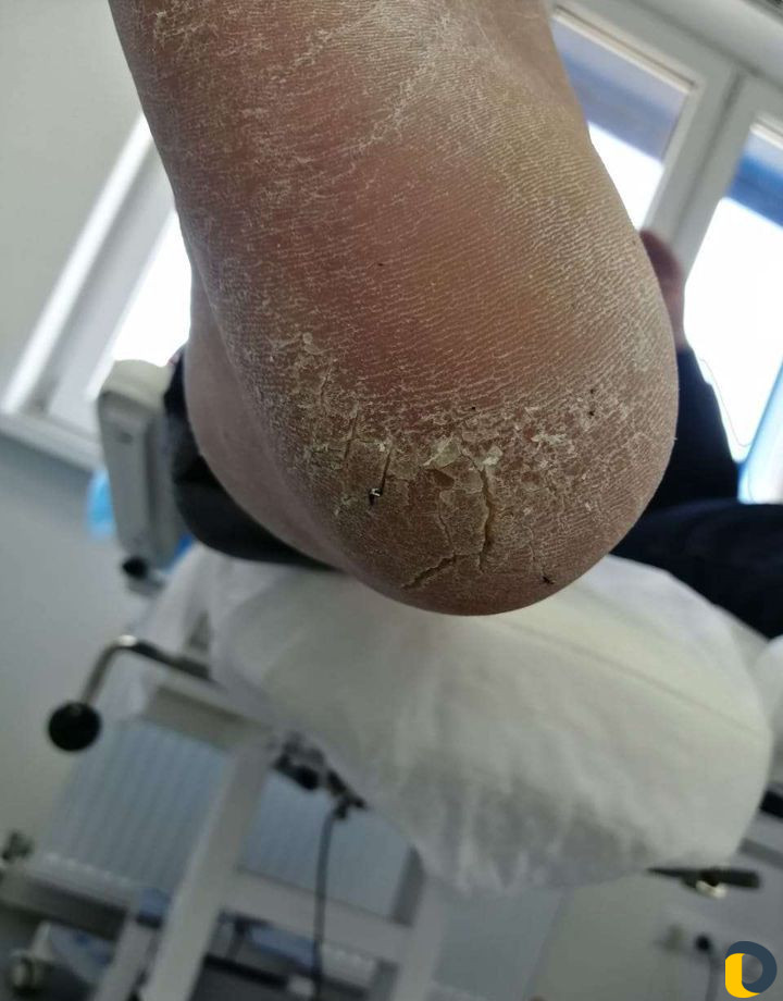 Аппаратный Педикюр. Выезд