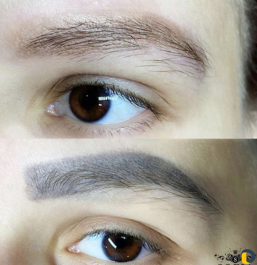 Бесплатное удаление татуировок