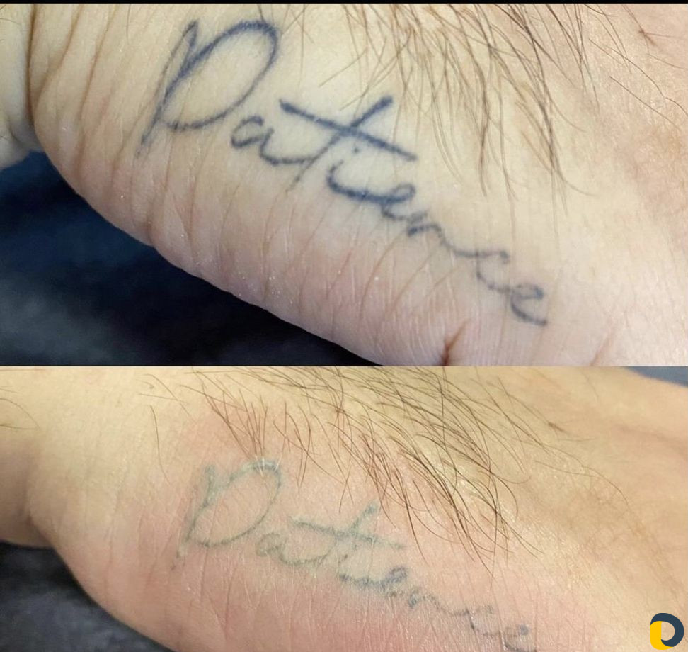 Бесплатное удаление татуировок