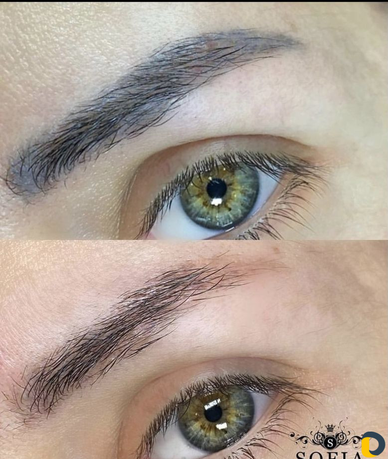 Бесплатное удаление татуировок