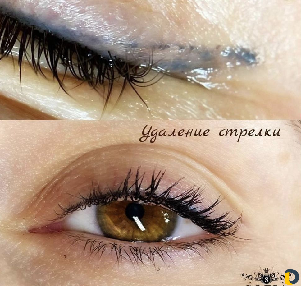 Бесплатное удаление татуировок