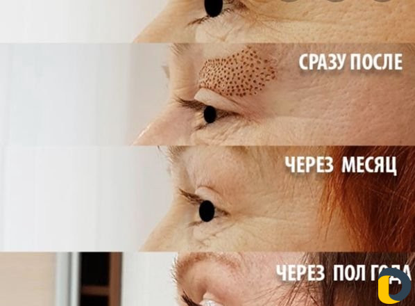 Безоперационная блефаропластика