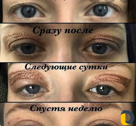 Безоперационная блефаропластика