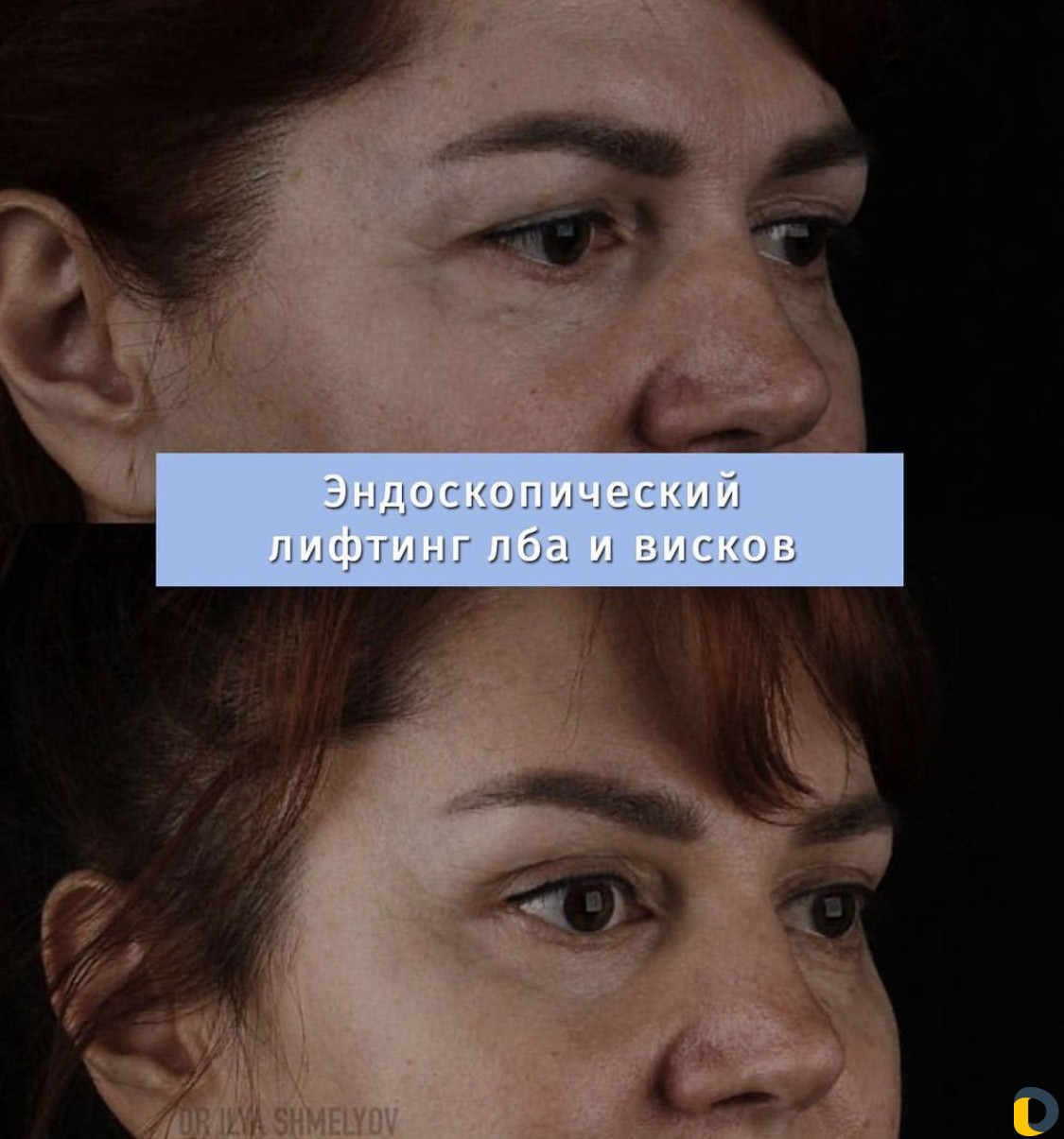 Блефаропластика