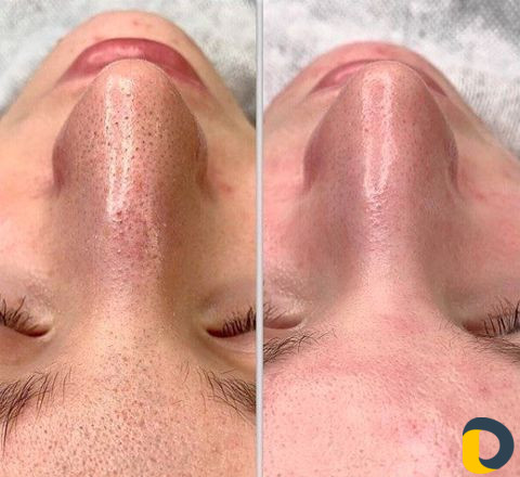 Чистка лица Holy Land