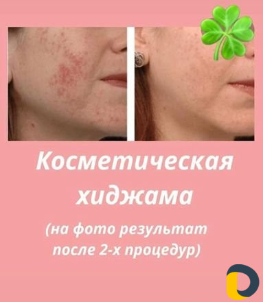 Делаю массаж детям и женщинам, Лечебный Антицеллюл