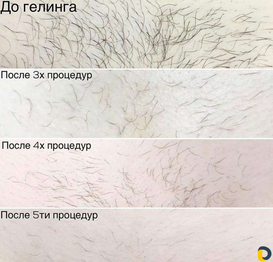 Депиляция Шугаринг Гелевая эпиляция Гелинг