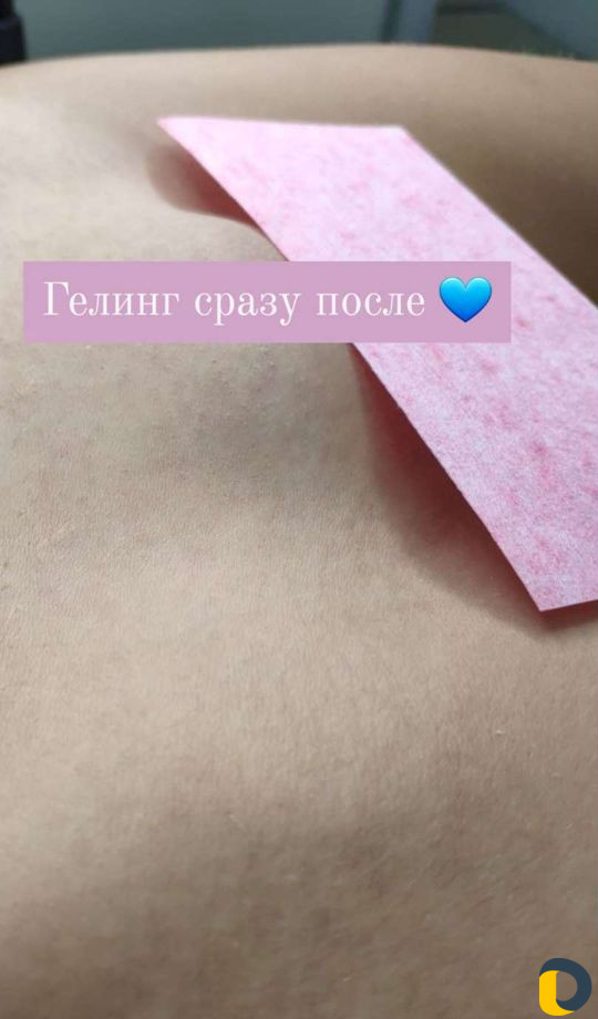 Депиляция Шугаринг Гелевая эпиляция Гелинг