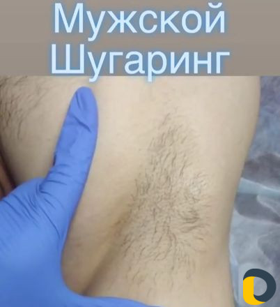 Депиляция