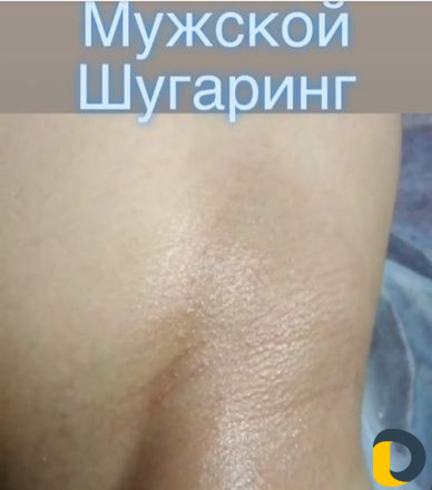 Депиляция