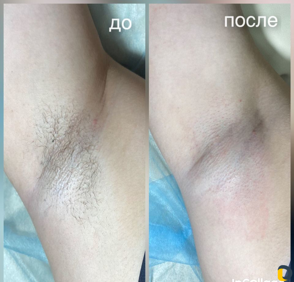 Депиляция: Воск, Шугаринг