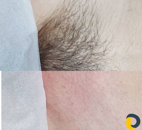 Депиляция воском