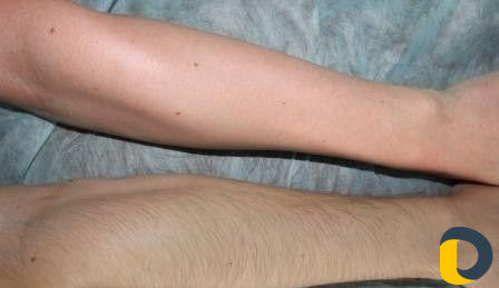 Депиляция воском (женский пол)