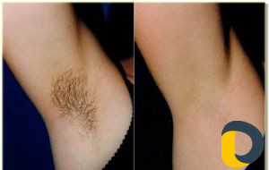 Депиляция воском (женский пол)