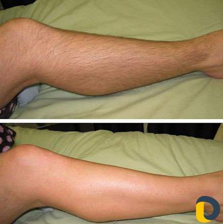 Депиляция воском (женский пол)