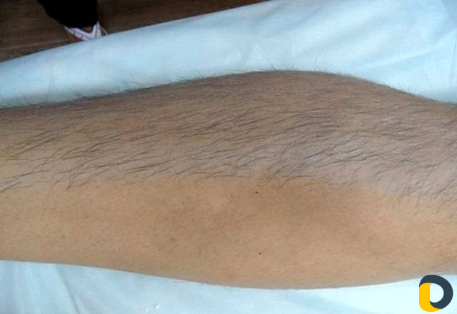 Депиляция воском (женский пол)