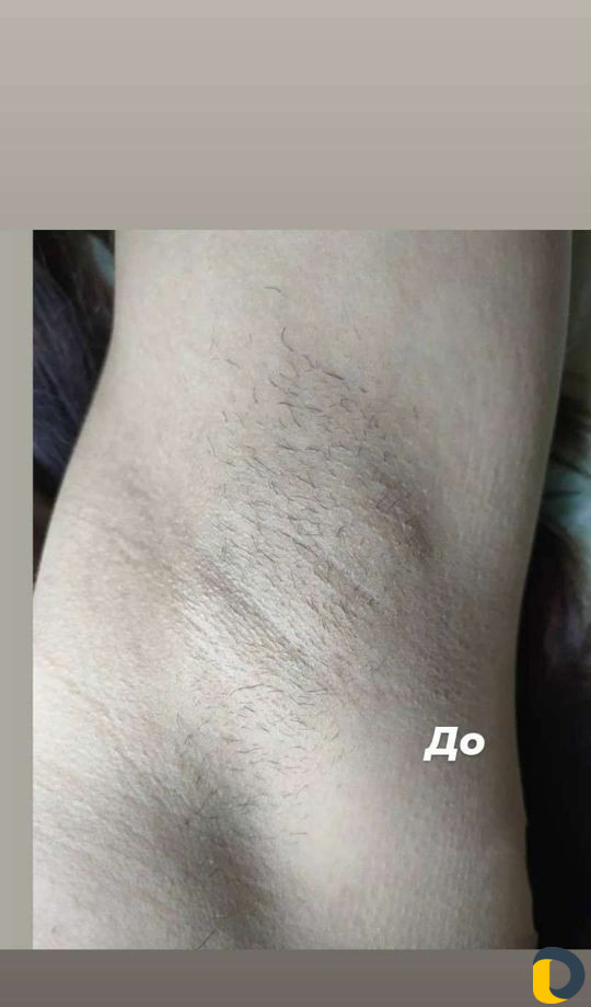 Электроэпилация