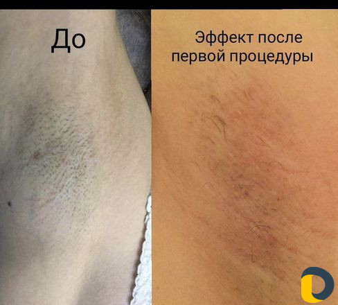 Электроэпиляция. elektroepilacia