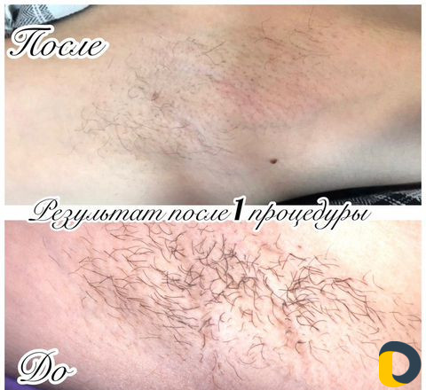Электроэпиляция. elektroepilacia