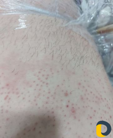 Электроэпиляция Каспийск