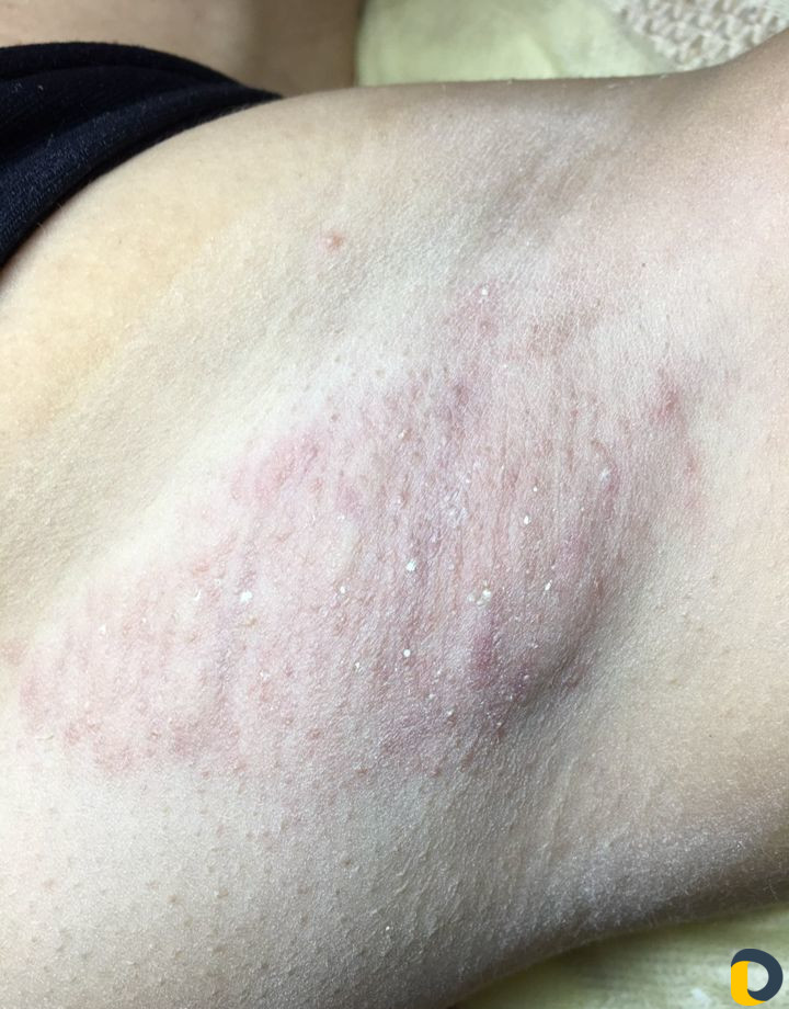 Электроэпиляция на дому