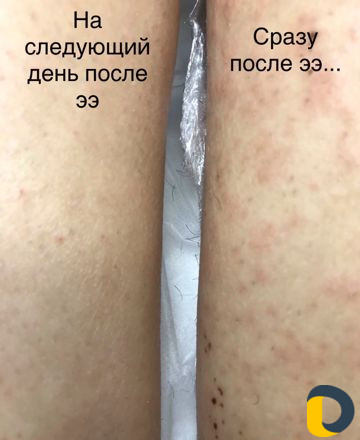 Электроэпиляция, шугаринг, ваксинг