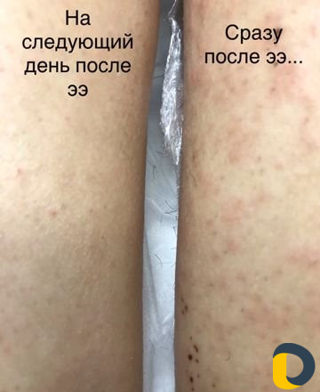 Электроэпиляция, шугаринг, ваксинг