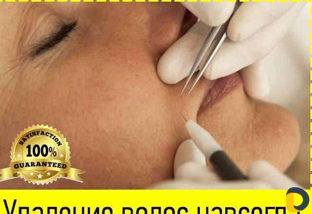 Электроэпиляция Удаление нежелательных волос