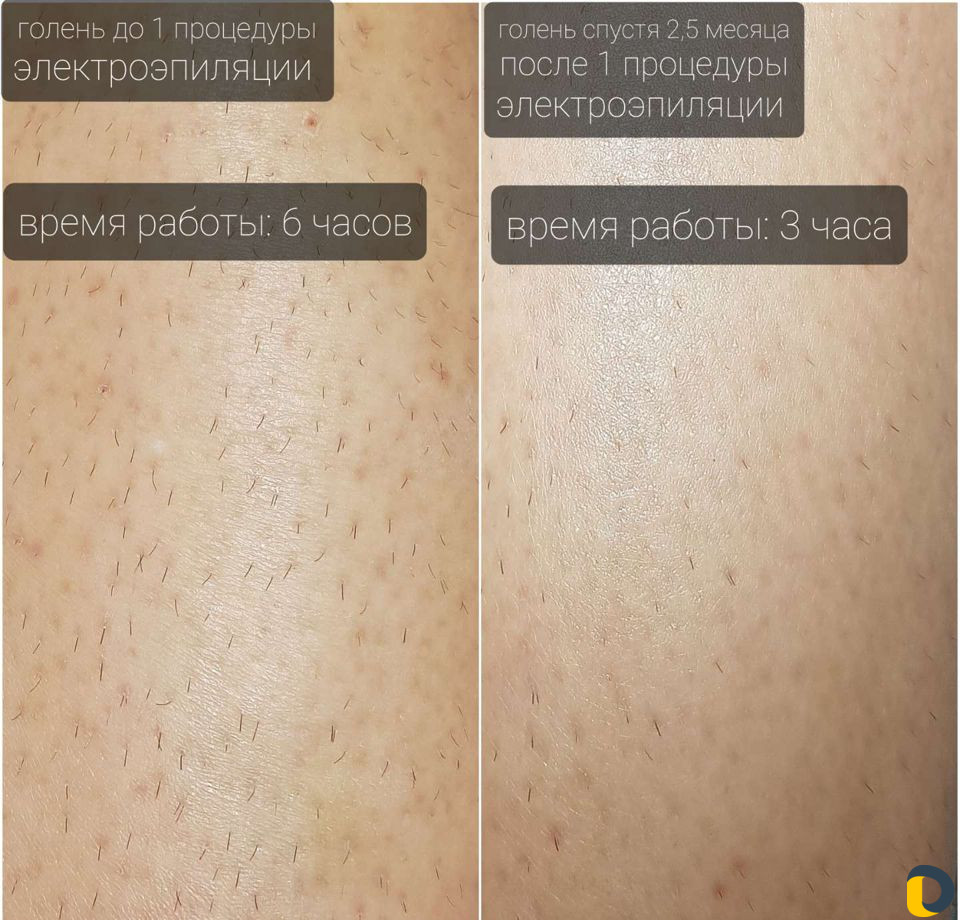 Электроэпиляция-удаление волос Навсегда