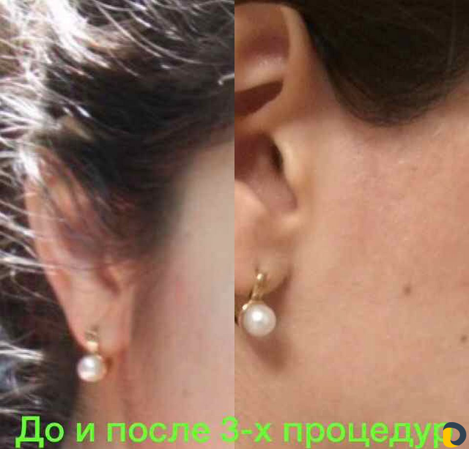 Электроэпиляция (удаление волос навсегда)