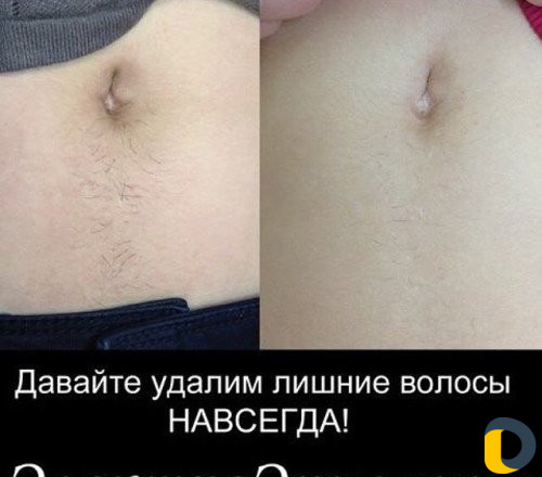 Электроэпиляция Удаление волос навсегда