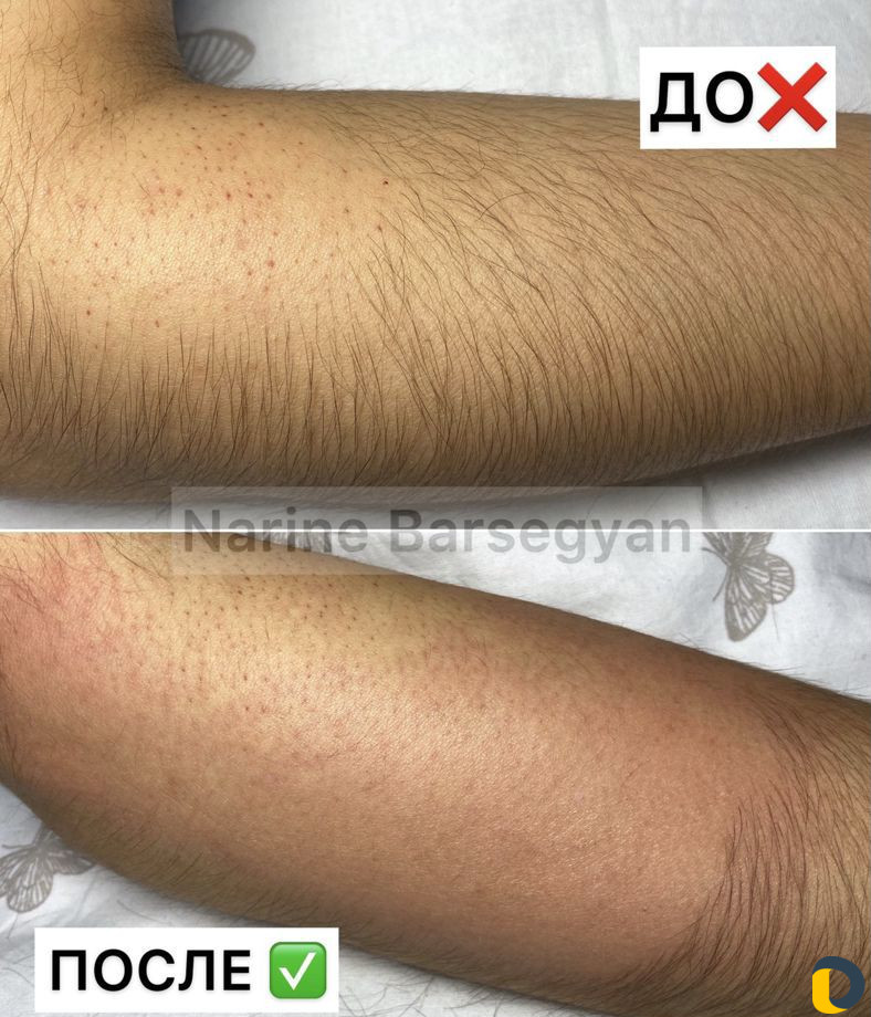 Электроэпиляция. Удаление волос. Обучение