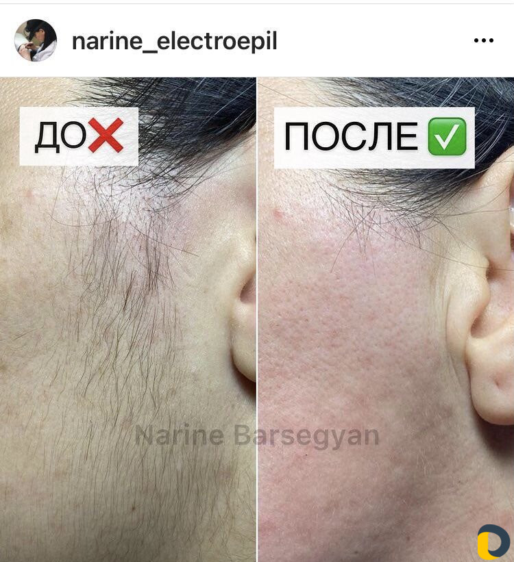 Электроэпиляция. Удаление волос. Обучение