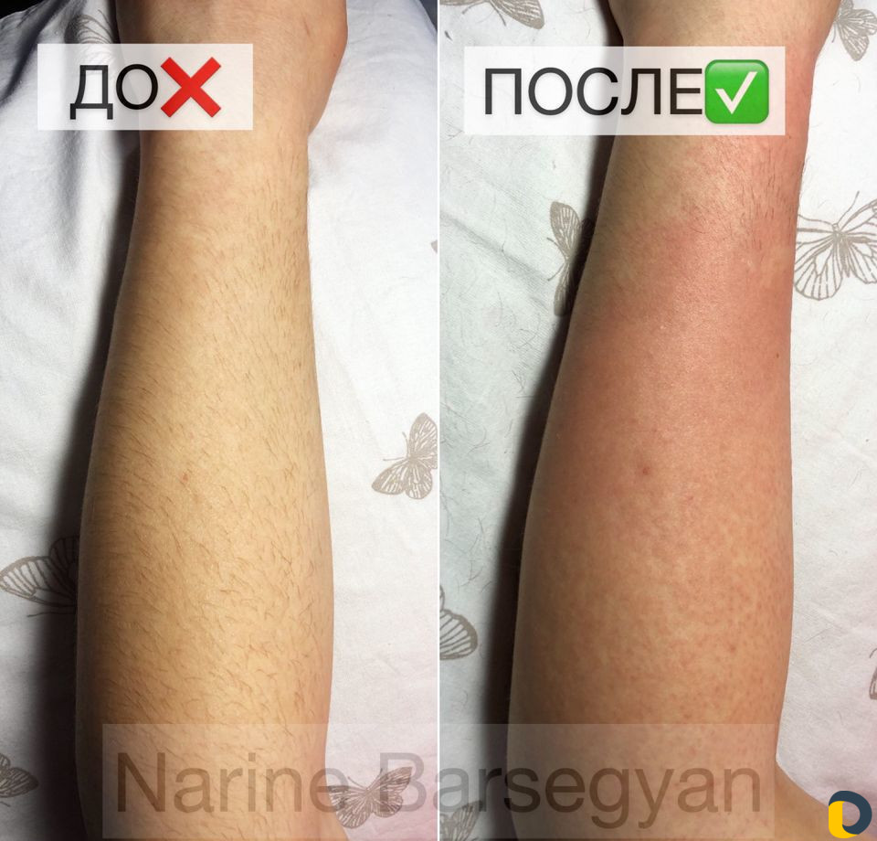 Электроэпиляция. Удаление волос. Обучение