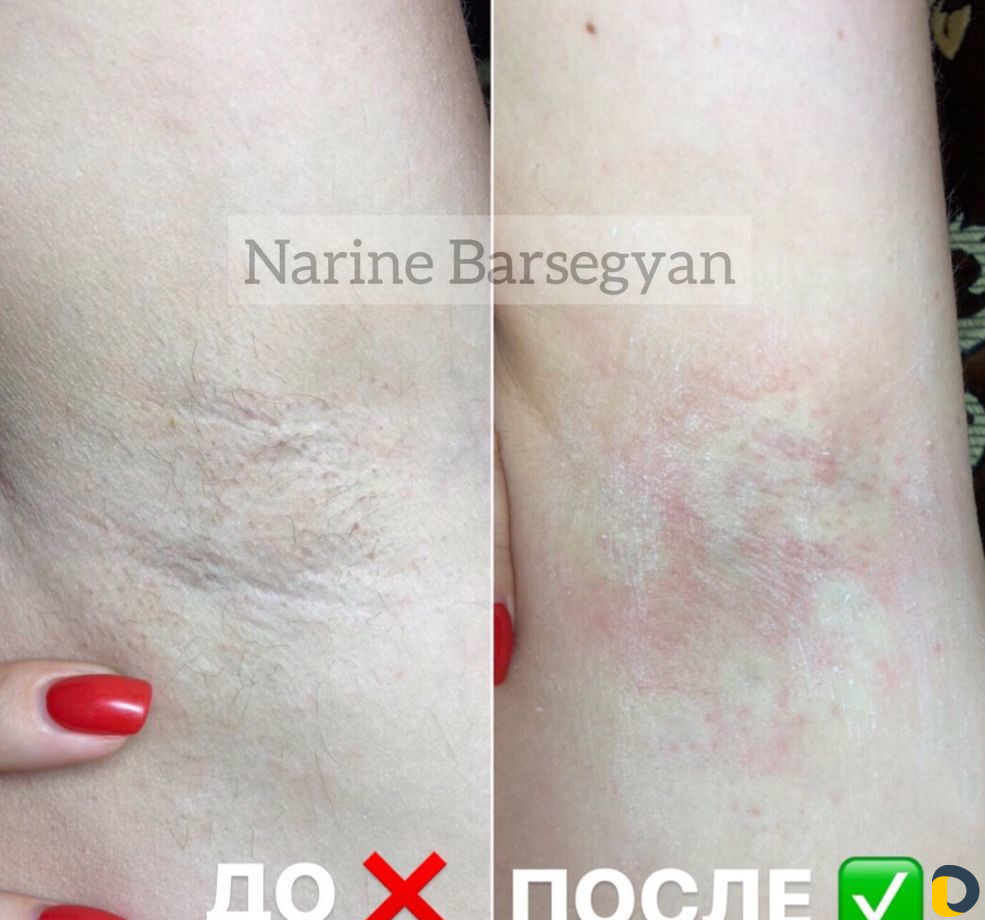 Электроэпиляция. Удаление волос. Обучение