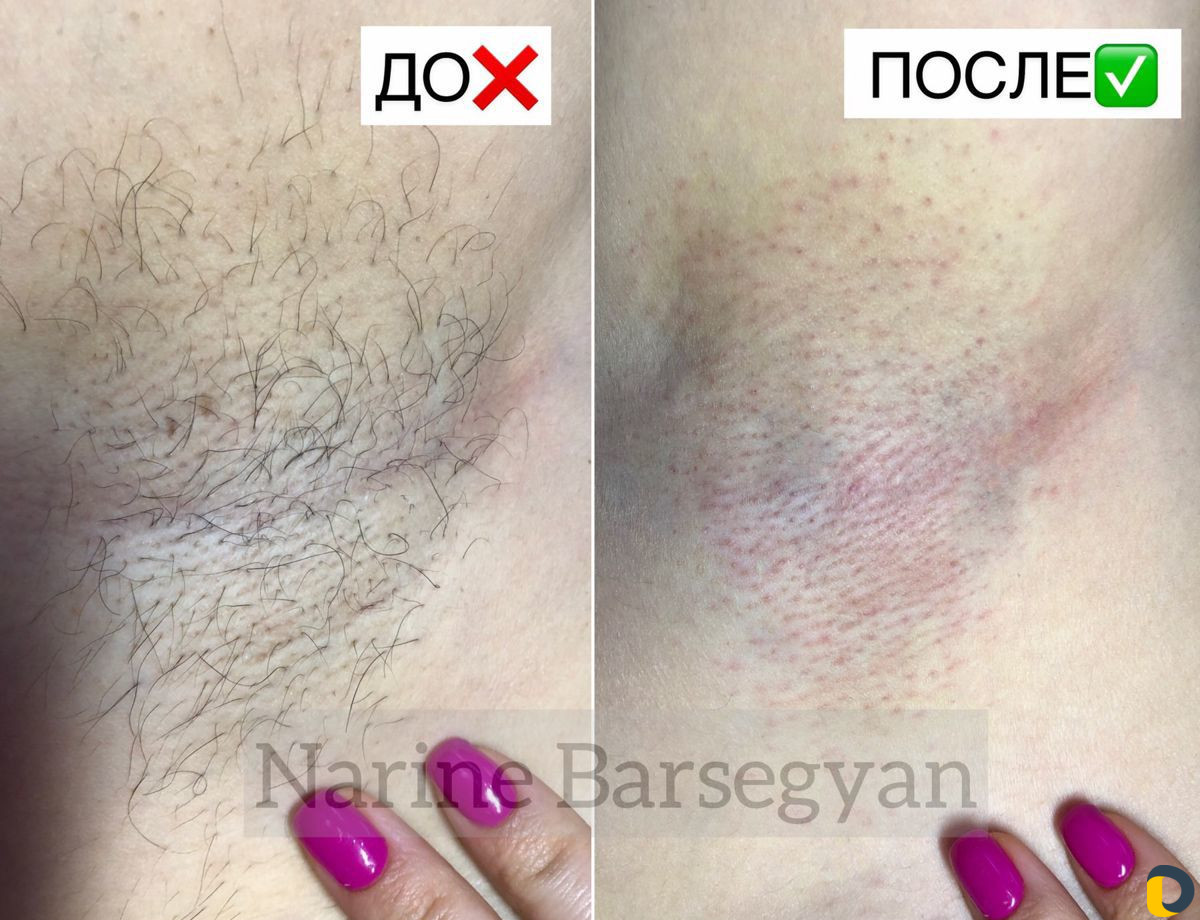 Электроэпиляция. Удаление волос. Обучение
