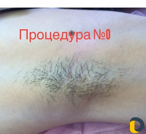 Электроэпиляция