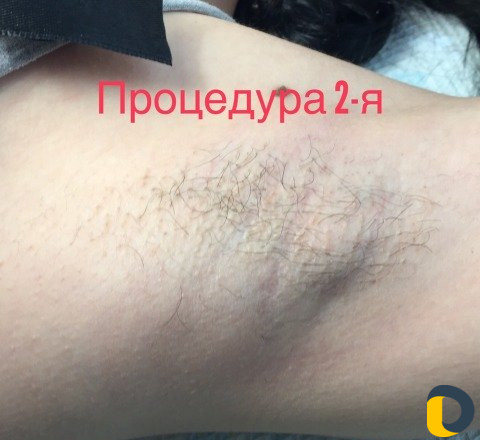 Электроэпиляция