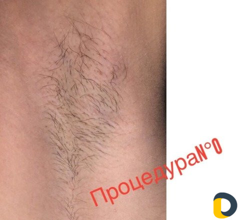 Электроэпиляция