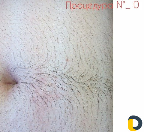 Электроэпиляция