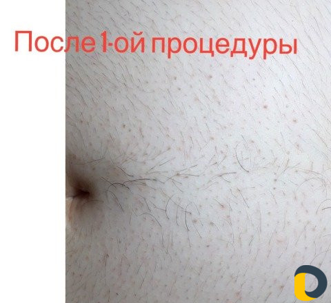 Электроэпиляция