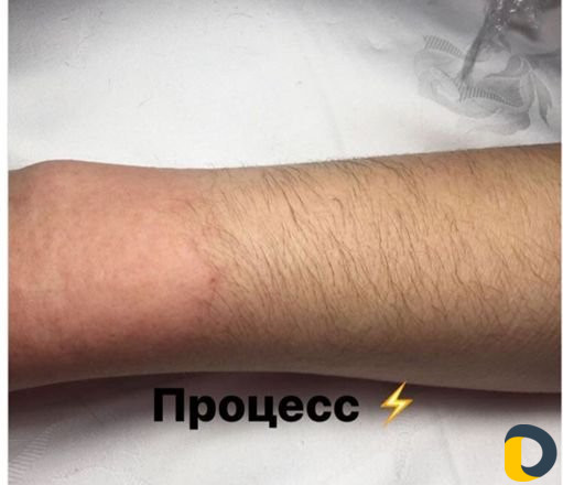 Электроэпиляция