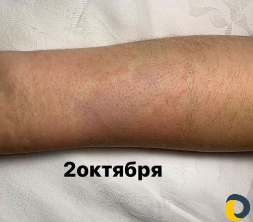 Электроэпиляция